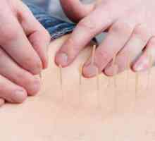 Použití akupunktury pro spinální kýly