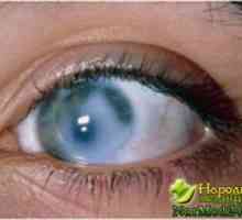 Symptomy a léčba glaukomu lidových prostředků