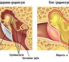 Příznaky zánětu středního ucha, zánět středního ucha, rozpoznat, kdy