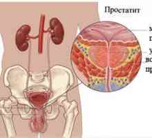 Symptomy prostatitidy