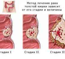 Léčba a prognóza adenokarcinomu sigmatu