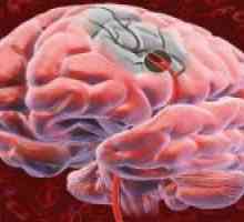 Prognóza a následky ischemickou cévní mozkovou příhodou
