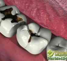 Osvědčená tipy lidoví léčitelé v léčbě zubního kazu