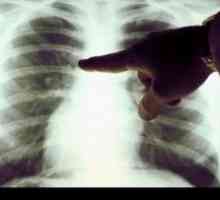 Rakovina plic