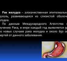 Rakovina žaludku: příznaky, příznaky a léčba