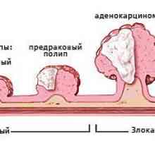 Rozpoznání a léčba rakoviny tlustého střeva