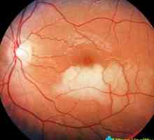 Stratifikace sítnice očí: příčiny a důsledky