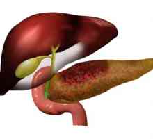 Příznaky a léčba alkoholického pankreatitida