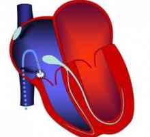 RF ablace srdce: charakteristika, příprava, zpracování, využití