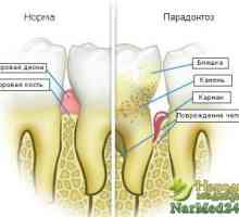 Recepty, jak se zbavit onemocnění parodontu na základě lidových prostředků