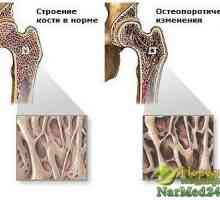 V lidovém léčitelství k léčbě osteoporózy