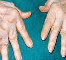 Revmatoidní artritida