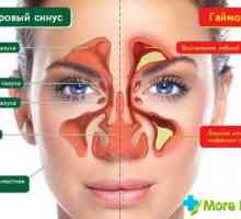Většina efffekivnye léky od zánětu vedlejších nosních dutin