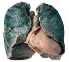 Plicní sarkoidóza