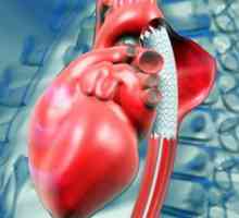 Srdeční aneurysma: příčiny, příznaky, jak se chovat