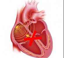 Srdeční blok: úplné nebo částečné, různé lokality - příčiny, příznaky, léčba