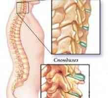 Cervikální spondylóza