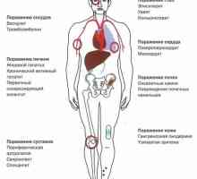 Symptomy, diagnóza a léčba Crohnovy choroby
