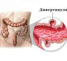 Symptomy divertikulární nemoc tlustého střeva