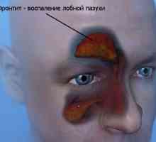 Příznaky zánětu vedlejších nosních dutin a základní metody léčby