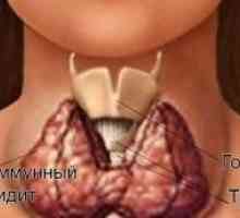 Příznaky a léčení autoimunitní thyroiditis