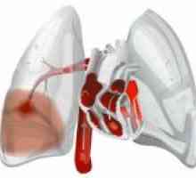 Plicní embolie (PE)