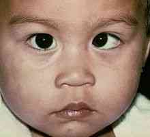 Syndrom líné oko (amblyopie) u dospělých a dětí
