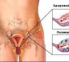 Syndromu polycystických vaječníků a těhotenství