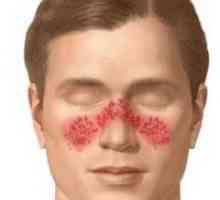 Systémový lupus erythematodes