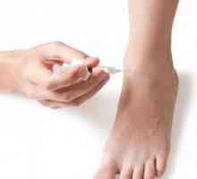Skleroterapie žíly nohou: efektivní metoda pro neběží varixů