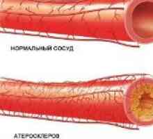 Cévní skleróza dolních končetin a jejich léčení