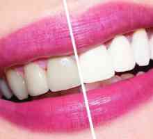Kolik bělení zubů v zubním lékařství?