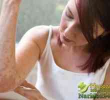 Tipy pro léčbu atopické dermatitidy doma