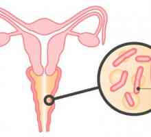Způsoby léčení kvasinkových infekcí u žen