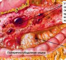 Typy a léčbu hemoragické nekrotizující pankreatitida