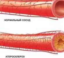 Konstriktivní ateroskleróza