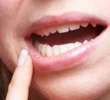 Jak zacházet s stomatitidu v ústech u dospělých? Osvědčené techniky a metody