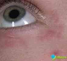 Vyrážka kolem očí - její příčiny a léčba
