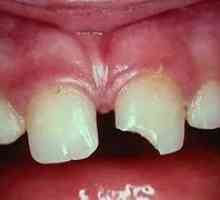 Zubní trauma