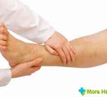 Trombophlebitis nohy: Jaké jsou příznaky onemocnění