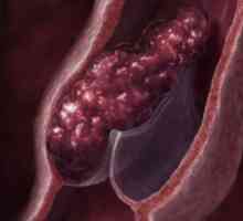 Trombóza hlubokých žil dolních končetin