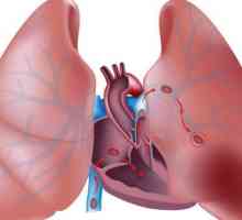 Embolie a trombóza plicnice