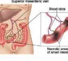 Trombóza mezenterických cév střeva