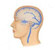 Trombóza mozkových dutin: příčiny, příznaky, léčba