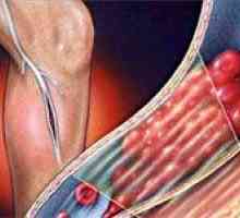 Trombóza hlubokých žil dolních končetin a jejich léčení