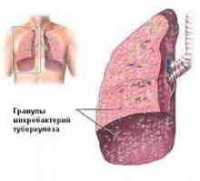 Plicní tuberkulóza