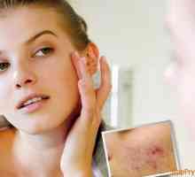 Care Facial - jak odstranit skvrny na obličeji všechny akné