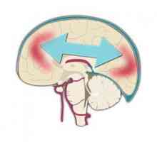 Poranění mozku: příčiny, příznaky a diagnostika, léčba, prognóza, rehabilitace