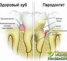 Úspěšná léčba parodontitidy lidových prostředků doma