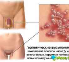 Zda herpes přenáší?